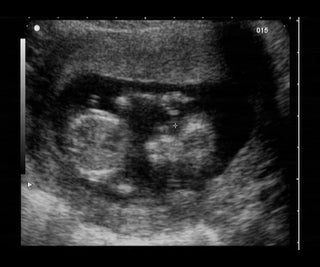 baby sonogram photo