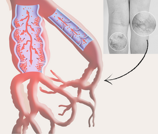 varicose veins in legs