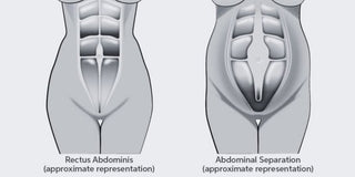 Addressing Diastasis Recti with Pilates and Physiotherapy - TheRY