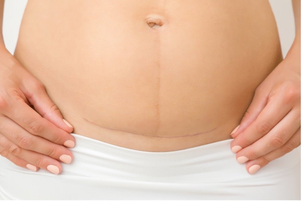 Caesarean Section Preparation and Recovery - TheRY
