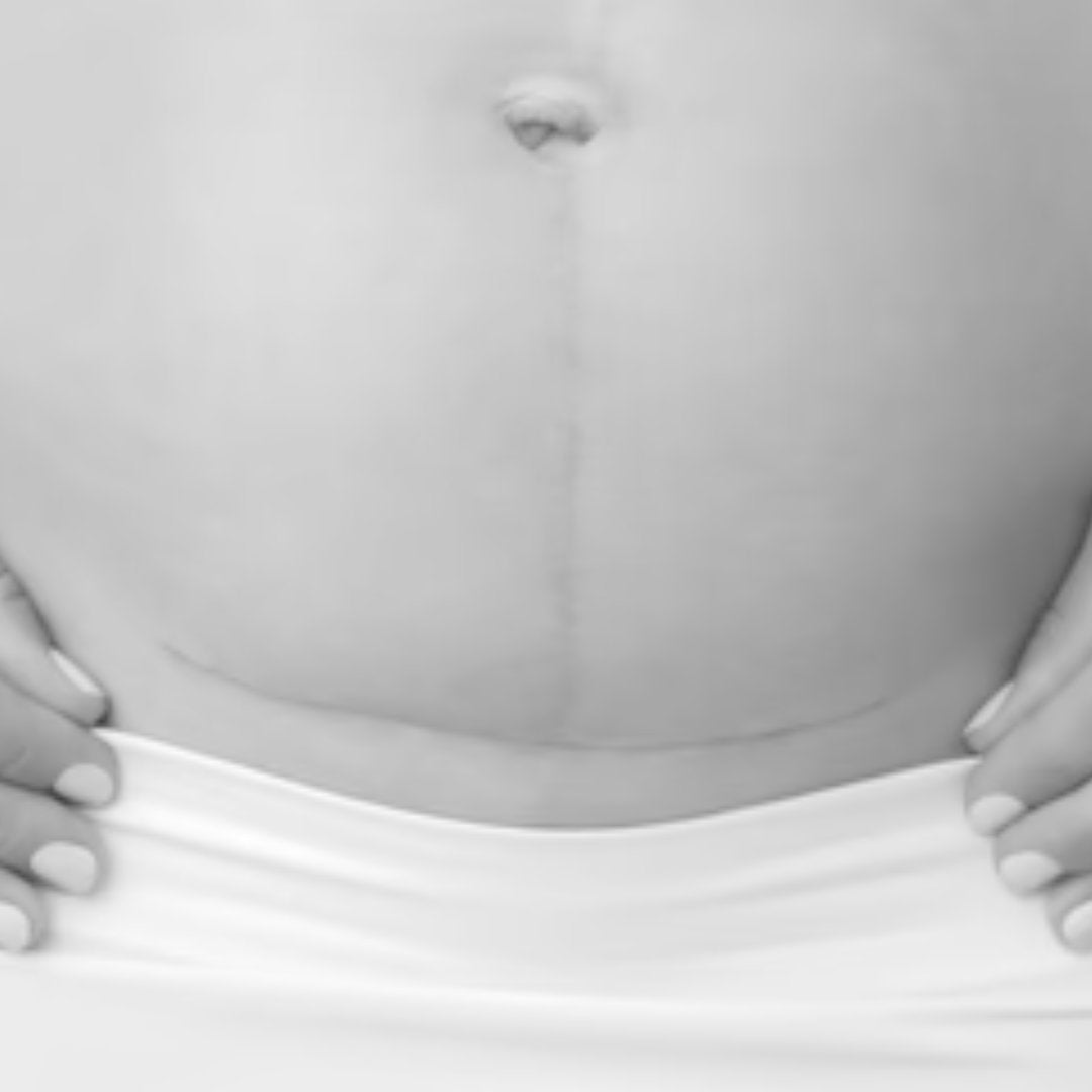 C-section surgery recovery & Postpartum Recovery from abdominal separation and swelling - TheRY
