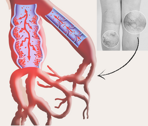 varicose veins diagram - abnormal and normal veins